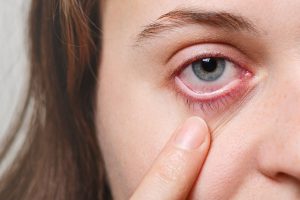 What is Uveitis? What are Types, Symptoms, and Treatment Methods?