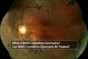 Bietti Crystalline Dystrophy